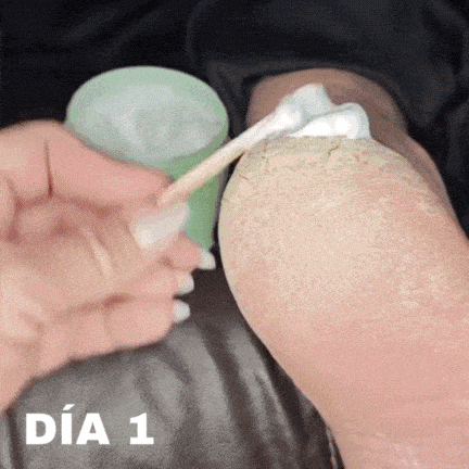 Tratamiento Urea 40% - Reparador pies partidos, rodillas y codos secos 🥇 PACK x 2 UDS