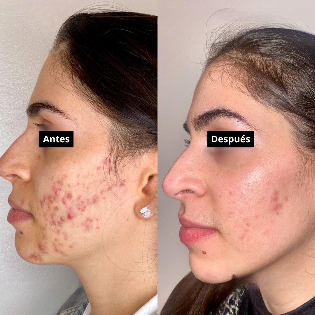 Tratamiento Antiacne - Elimina brotes y disminuye cicatrices🥇HOY 45% OFF
