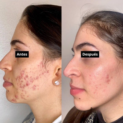 Tratamiento Antiacne - Elimina brotes y disminuye cicatrices🥇HOY 45% OFF