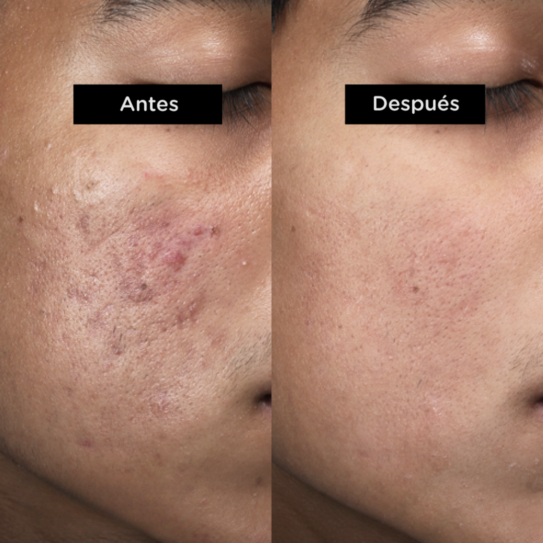Tratamiento Antiacne - Elimina brotes y disminuye cicatrices🥇HOY 45% OFF
