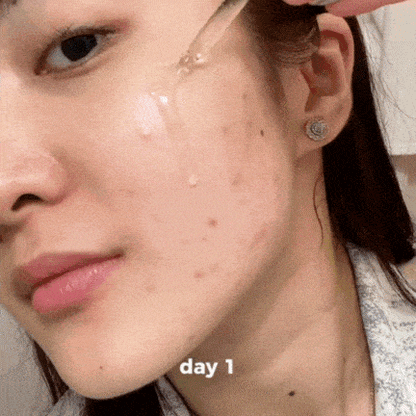 Tratamiento Antiacne - Elimina brotes y disminuye cicatrices🥇HOY 45% OFF